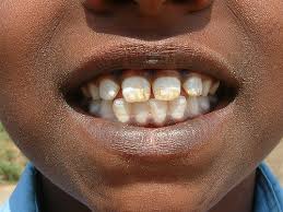 amoxicillin side effects + teeth staining