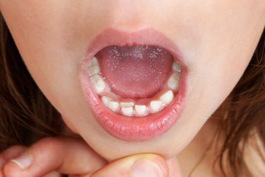 loss of deciduous teeth in children and early puberty