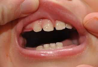 discoloration of kids teeth